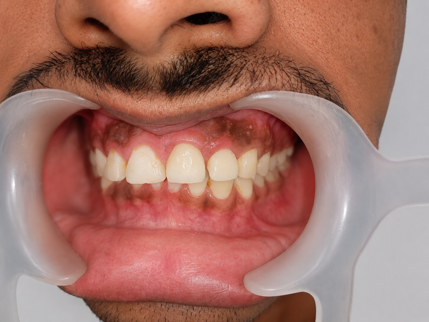 After dental implant treatment - restored smile - Shivaay Gum Care Dental Clinic Thane