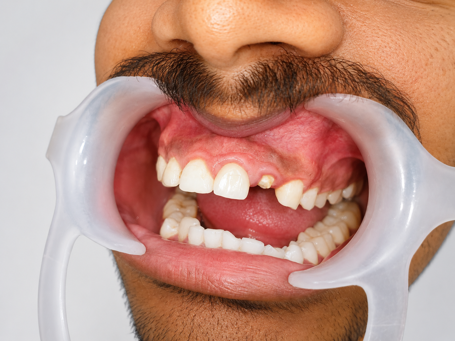 Before dental implant treatment - missing tooth and gum issues - Shivaay Dental Clinic Thane
