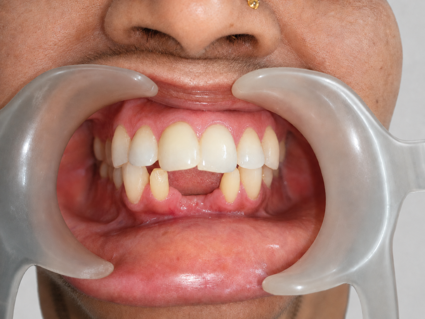 Before dental implant treatment - missing tooth and gum issues - Shivaay Dental Clinic Thane