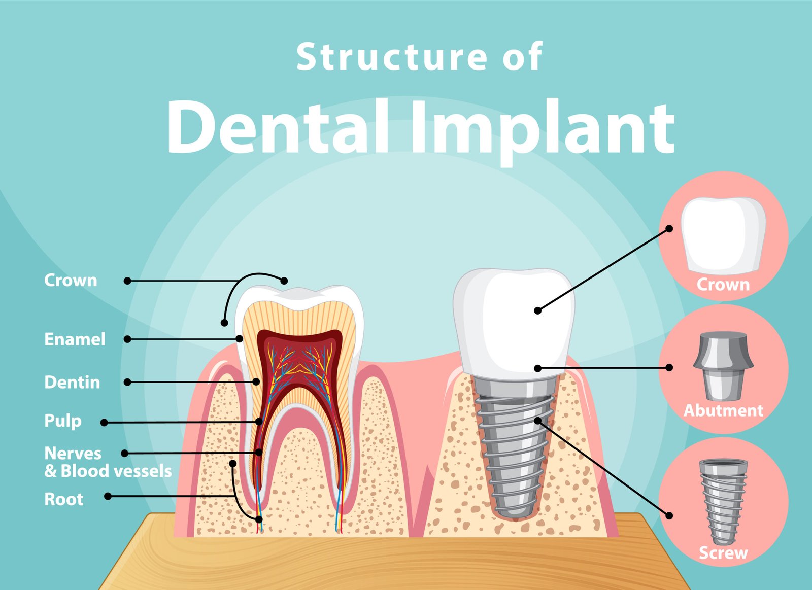 Infographic Of Human In Structure Of The Dental Implant